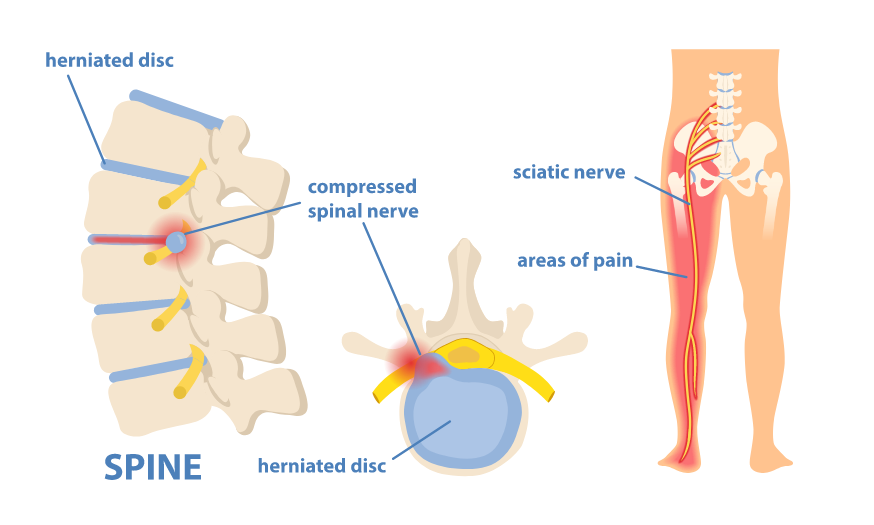 A 2-D infographic about sciatica, showing where the herniated disk compresses the spinal nerve and causes pain from the Sciatic nerve down the leg.
